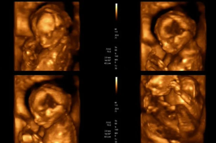 Usg Obstetrics (2d_3d_4d)